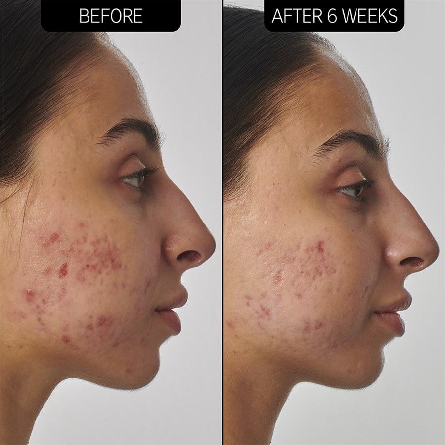 The INKEY List Sieri SuperSolutions 1% Retinol Serum Nuova