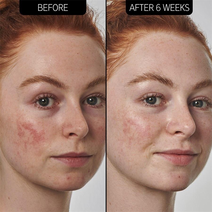 The INKEY List Sieri SuperSolutions 10% Azelaic Acid Serum Latest fashion