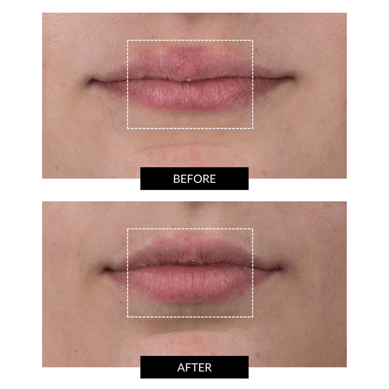 CurrentBody Skin LED Lip Perfector 2025