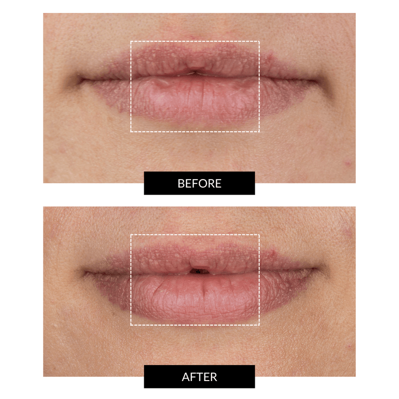 CurrentBody Skin LED Lip Perfector 2025