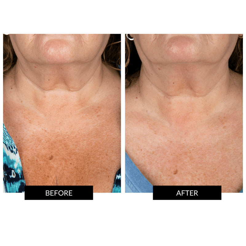 CurrentBody Skin Maschera Collo e Décolleté Soddisfazione Garantita