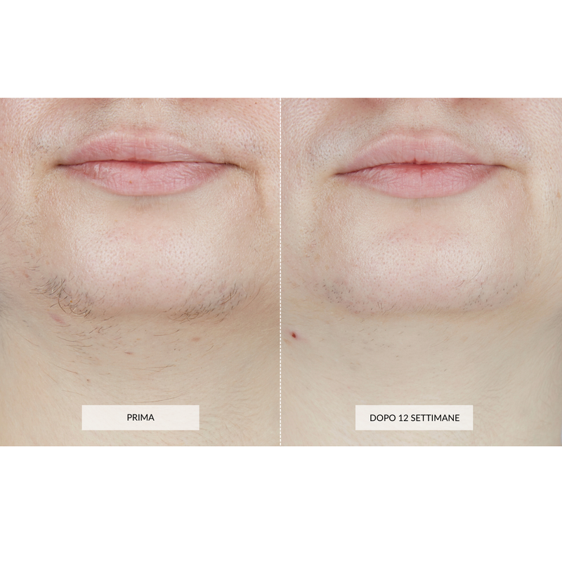 CurrentBody Skin Dispositivo di Epilazione Laser Consegna Veloce
