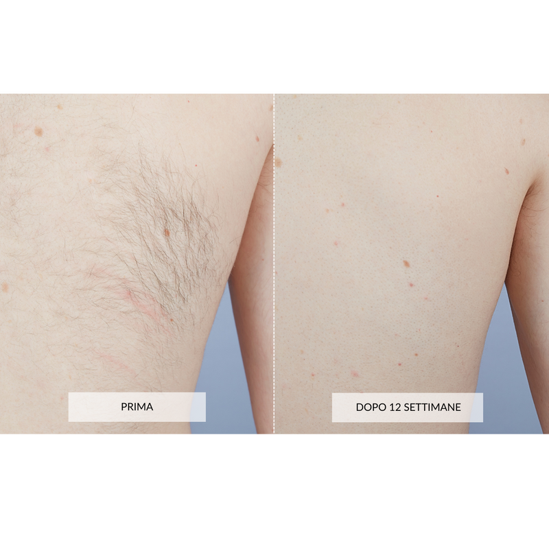 CurrentBody Skin Dispositivo di Epilazione Laser Consegna Veloce