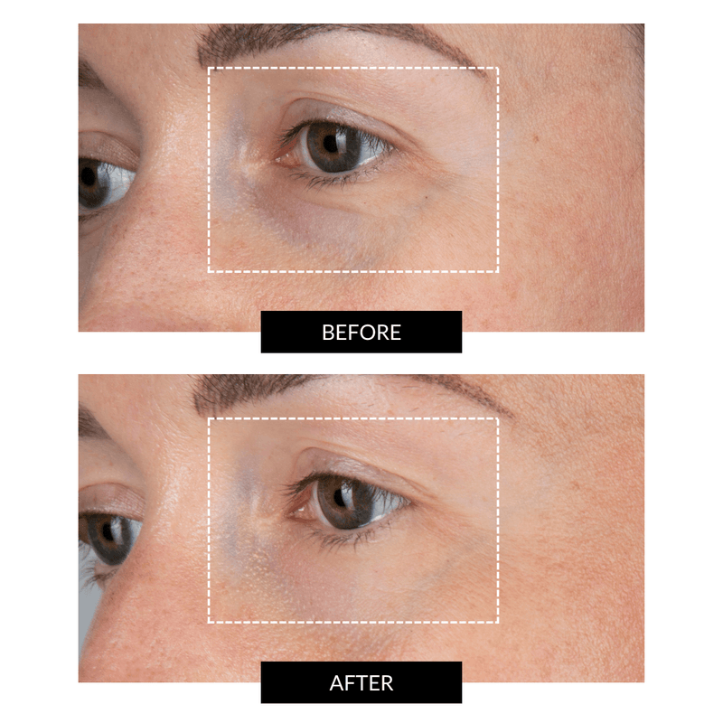 CurrentBody Skin LED Eye Perfector & 5 Eye Hydrogel Masks (del valore di 249€) 2025