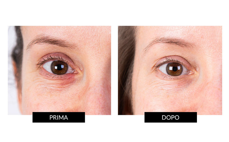 Nira Skin Nira Precision Laser Spedizione Gratuita