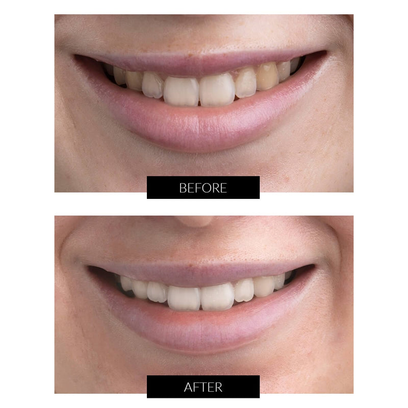 CurrentBody Skin Offers CurrentBody Skin Kit Sbiancamento Denti LED Offerta Convenienza