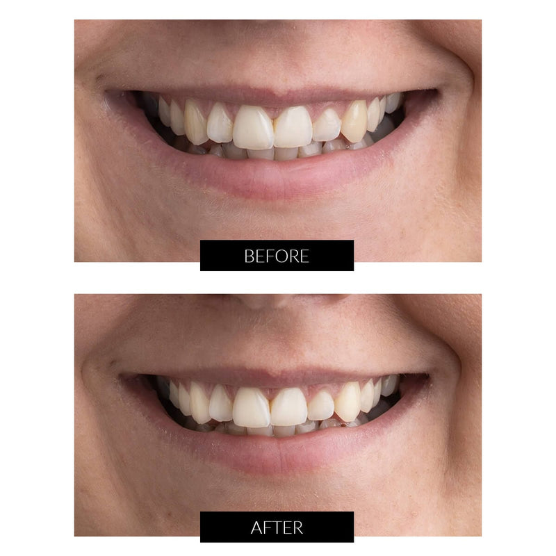 CurrentBody Skin Offers CurrentBody Skin Kit Sbiancamento Denti LED Offerta Convenienza